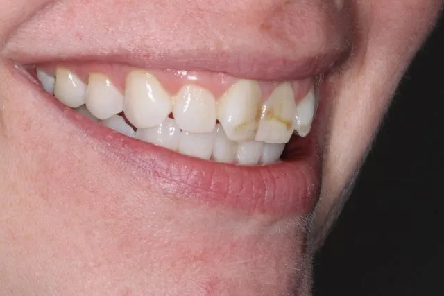 Before Prepless Veneers