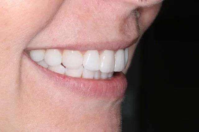 After Prepless Veneers