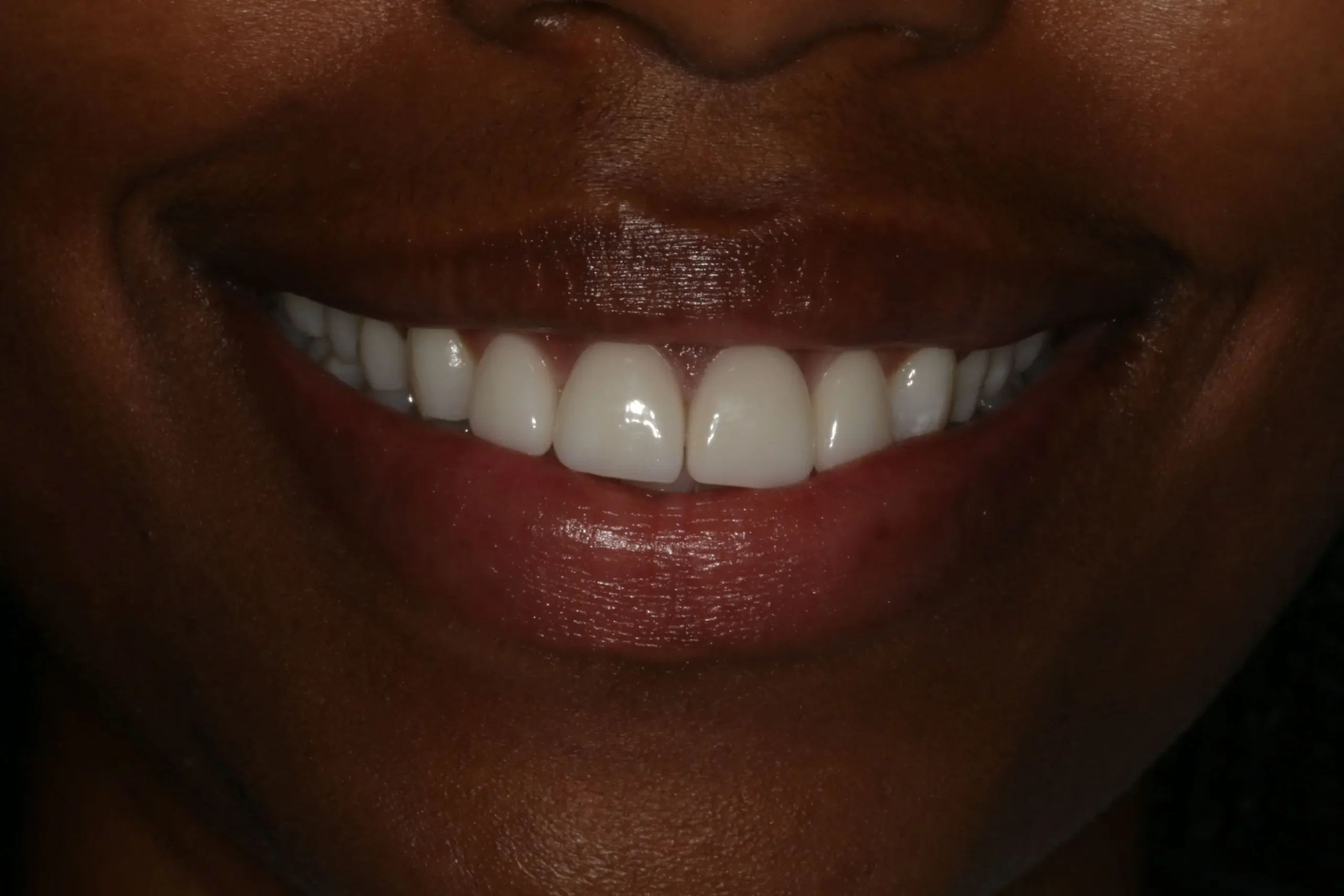 Before Prepless Veneers