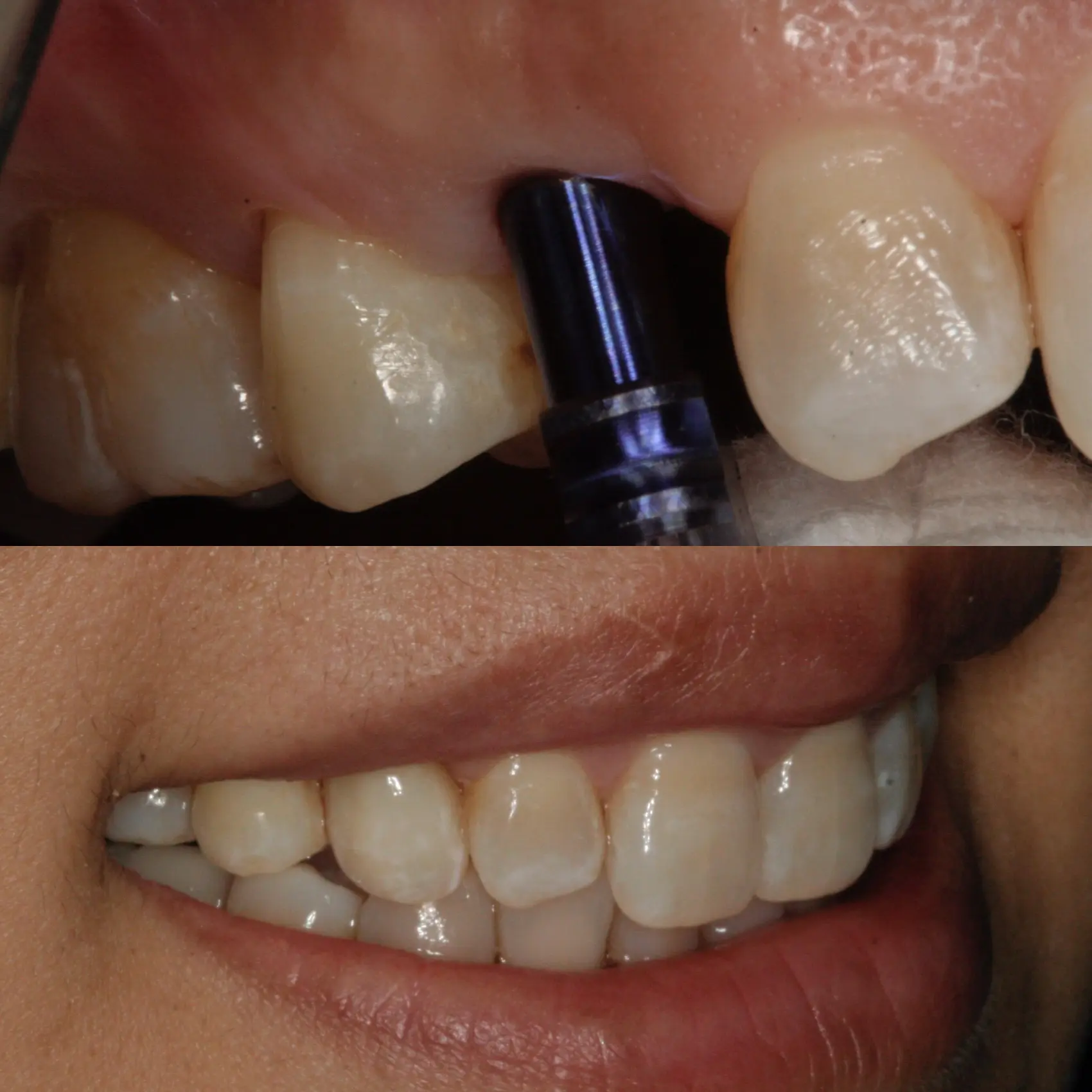 Dental Implant Washington DC