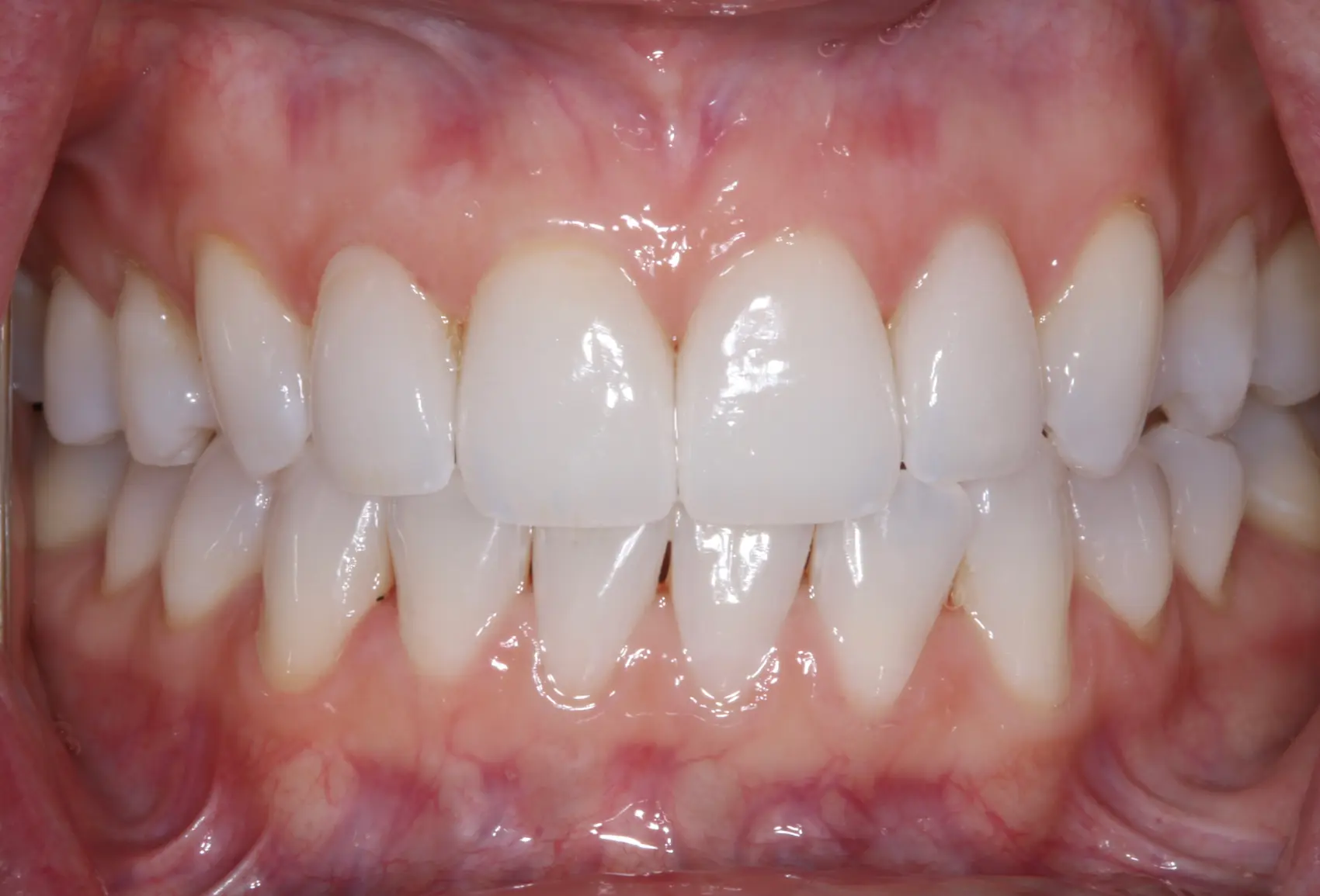 After Veneers